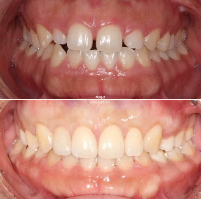 30대 치아교정 돌출입 교정 :: 잇몸미소 거미스마일 교정 입술부전증 결손치 무턱교정 관련 이미지 18