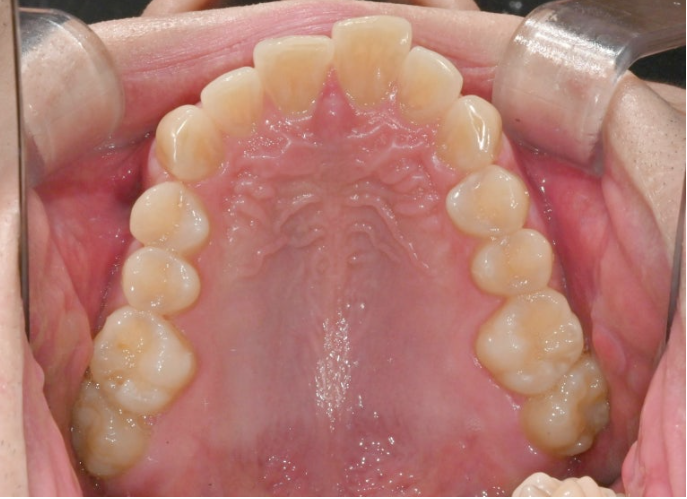 인비절라인 라이트 돌출 과개교합 중심선 교정 치간삭제 치료기간 관련 이미지 5
