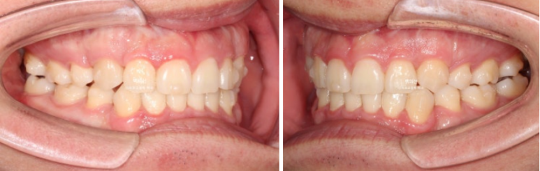 돌출입 수술 ASO + 인비절라인 라이트 후교정 치료기간 10개월 관련 이미지 9