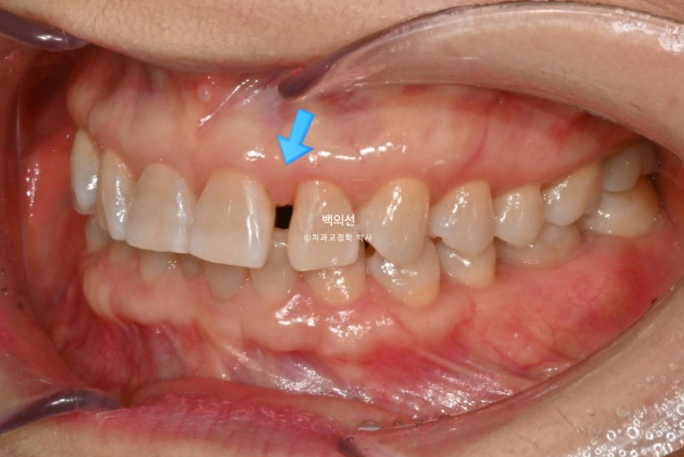 50대 치아교정 :: 인비절라인 익스프레스 치아 벌어짐 단기교정 후기 관련 이미지 8