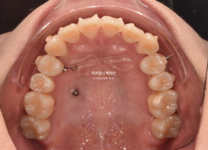 비발치 교정 덧니 인비절라인 교정 절단교합 반대교합 치료기간 1년 6개월 관련 이미지 12