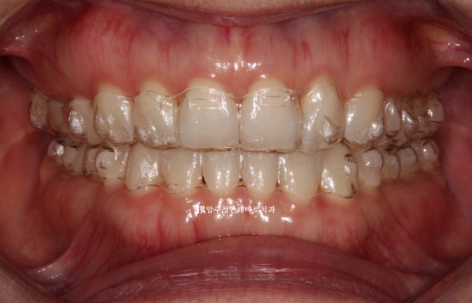 인비절라인 라이트 가위교합 벌어짐 중심선 미니스크류 치료기간 11개월 관련 이미지 4