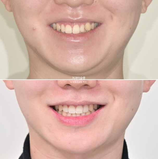 비대칭 비발치 거미스마일 잇몸미소 중심선 가위교합치료 무삭제 라미네이트 관련 이미지 1