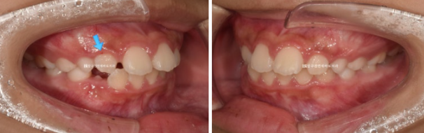강남 소아교정 인비절라인 퍼스트 어린이 반대교합 관련 이미지 3