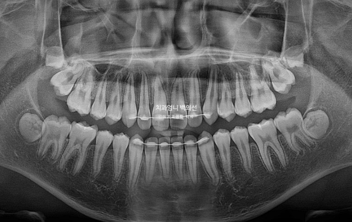 어린이 투명교정 인비절라인 퍼스트 가위교합 돌출교정 덧니교정 관련 이미지 16
