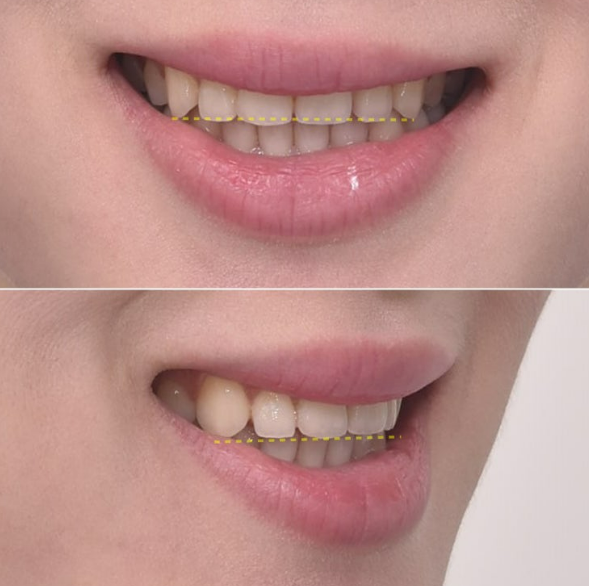 How to Create a Beautiful Smile Line? | A Real Case of Changing a Smile with No-Prep Laminates image 5