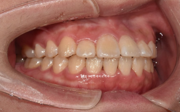 서울 인비절라인 치과 재교정 뻐드렁니 교정 관련 이미지 2