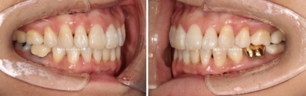 50대 중년교정 인비절라인 라이트 나비치아 교정 앞니 교정 후기 관련 이미지 10