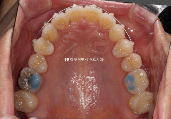 Short-Term Orthodontic Treatment Period for an Overseas Korean in Their 40s with Anterior Crossbite and Buck Teeth image 6