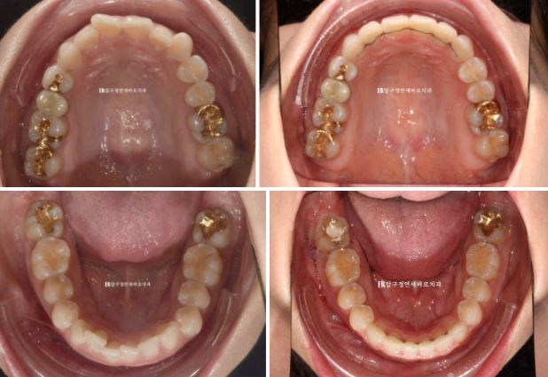 웃을 때 잇몸이 보여요. 잇몸미소 거미스마일 교정하기 관련 이미지 9