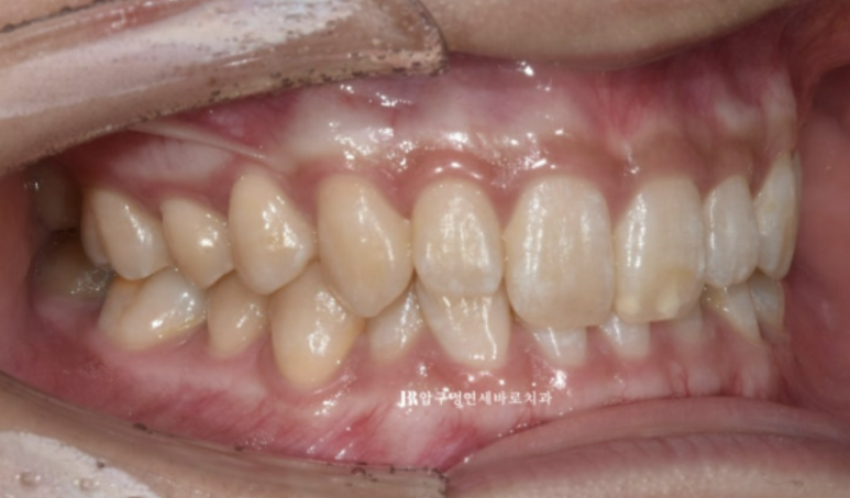 옥니교정 / 웃을때 아랫니만 보여요. 앞니 노출도 교정? 관련 이미지 1