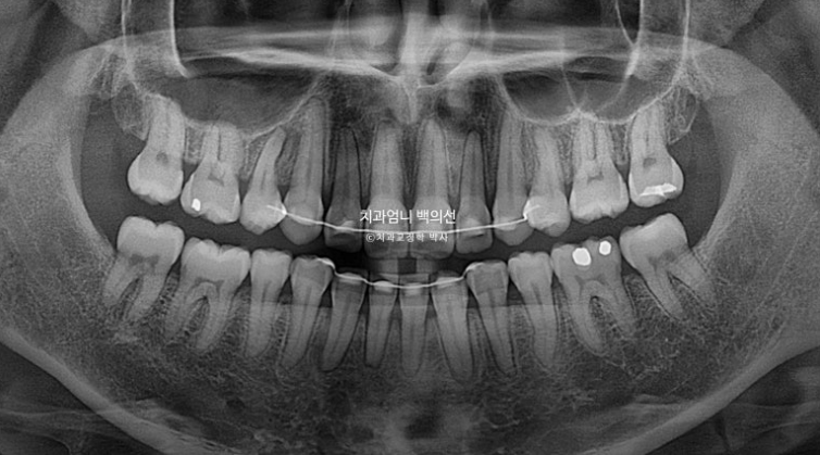 30대 교정 돌출입 교정 덧니 발치교정 치료기간 1년 8개월 관련 이미지 18
