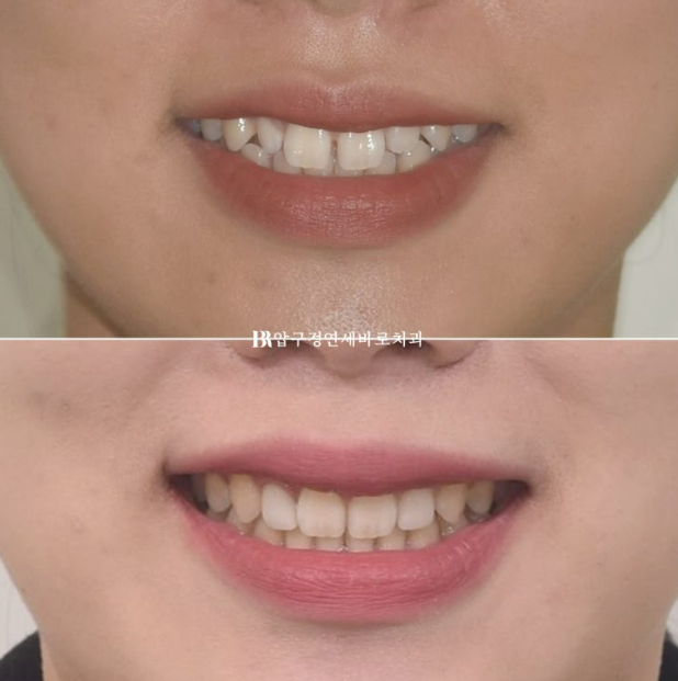 벌어진 앞니, 인비절라인과 무삭제 라미네이트로 자연스럽게 해결 관련 이미지 12