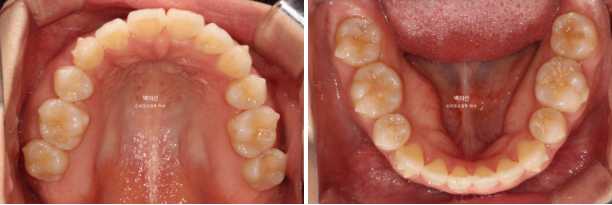 30대 돌출입 덧니 교정 인비절라인 발치교정 후기 관련 이미지 11