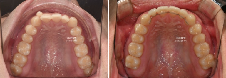 옥니 덧니 교정 왜소치 선천적 결손 3전치 무삭제 라미네이트 인비절라인 교정 관련 이미지 17