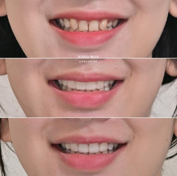 앞니 선천적 결손 벌어짐 잔존 유치 무삭제 라미네이트 관련 이미지 13