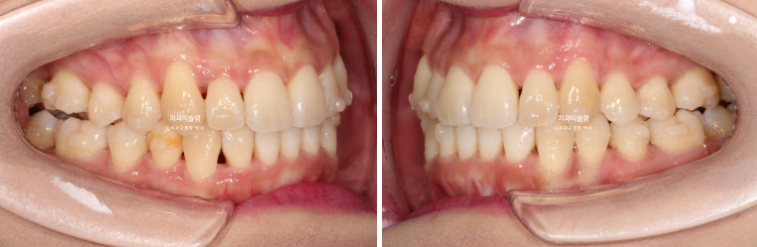 인비절라인 비발치 제2대구치 발치 사랑니 대체 교정 심한 덧니 교정 치료 관련 이미지 15