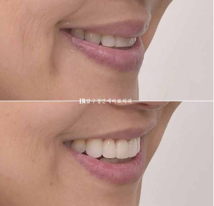 How to Avoid Regretting No-Prep Laminate Veneers: The Fitting Process Revealed image 6