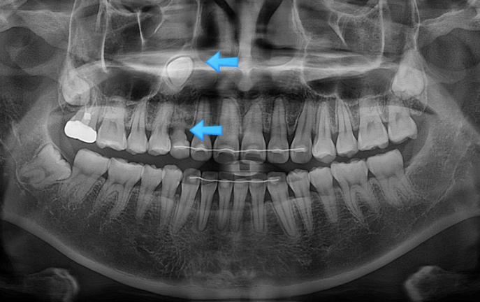 매복 결손 잔존유치 라미네이트 크라운 캔팅 인비절라인 라이트 치료 관련 이미지 3
