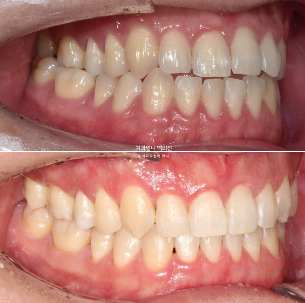 MSE Palatal Expansion Invisalign Underbite Correction, Non-Surgical image 21