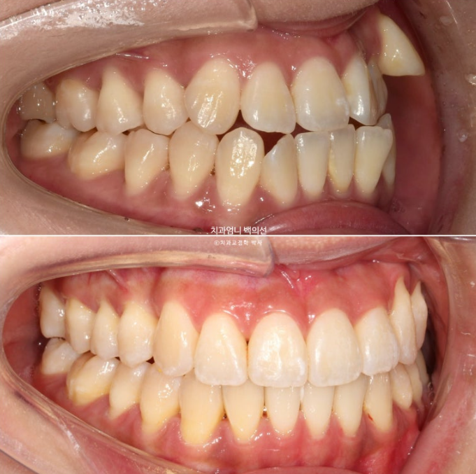 비발치 교정 덧니 인비절라인 교정 절단교합 반대교합 치료기간 1년 6개월 관련 이미지 23