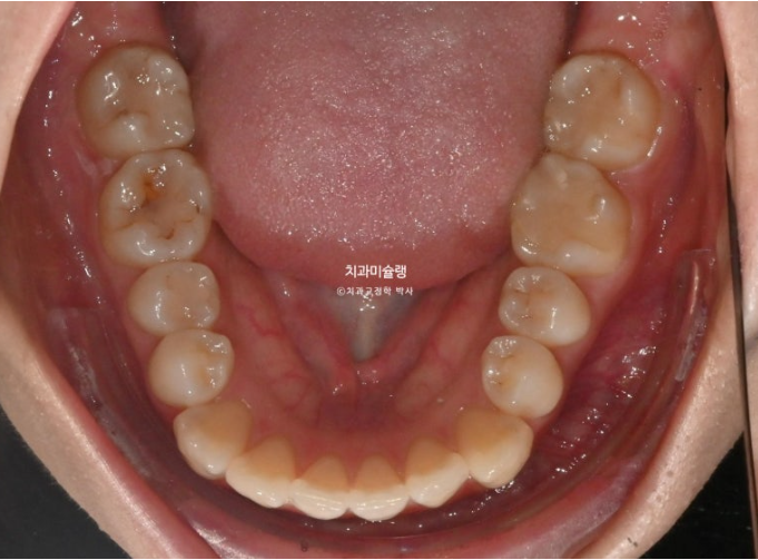 인비절라인 라이트 반대교합? 덧니 중심선 치간삭제 치료 관련 이미지 6