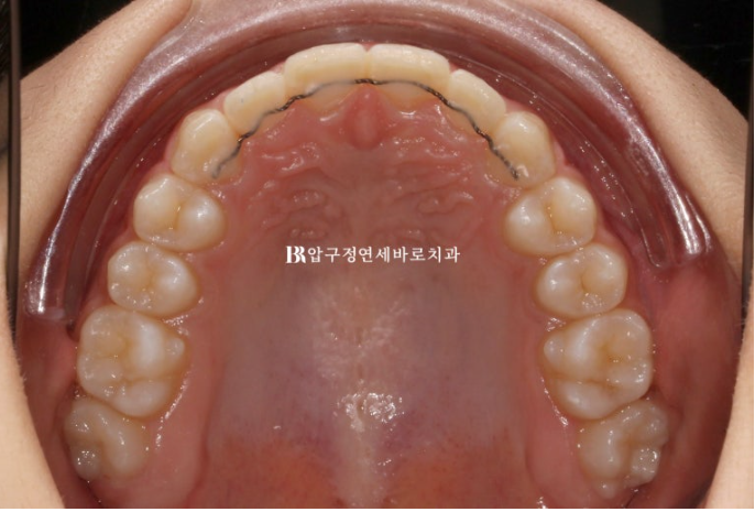 인비절라인라이트 덧니 과개교합 교정 치료기간 9개월 관련 이미지 10