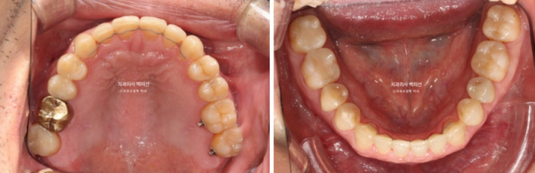 40대 인비절라인 비수술 비발치 주걱턱 비대칭 교정 관련 이미지 11