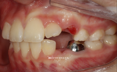 소아 투명교정 인비절라인 퍼스트 후기 기록 관련 이미지 7