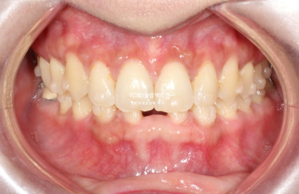 해외거주 앞니 선천적 결손 과개교합 인비절라인 라이트 브릿지 치료 관련 이미지 10