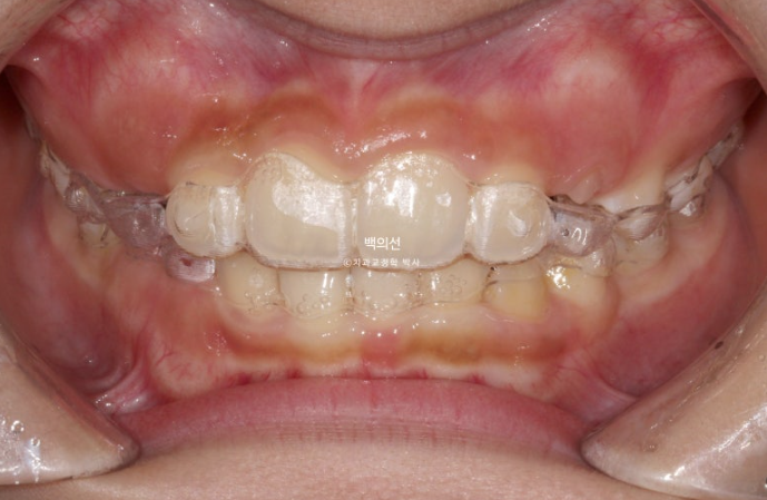 인비절라인퍼스트 어린이 투명교정 과개교합 덧니 악궁확장 돌출 관련 이미지 6