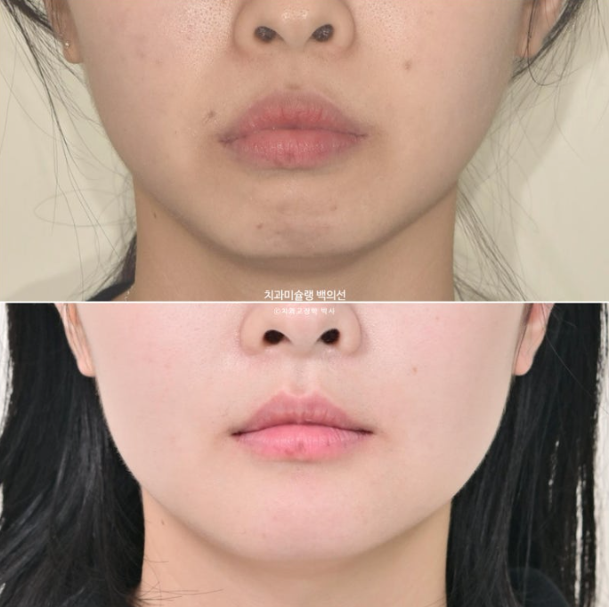 돌출입 인비절라인 발치교정 거미스마일 잇몸미소 잇몸돌출 입술부전증 무턱 재교정 관련 이미지 20