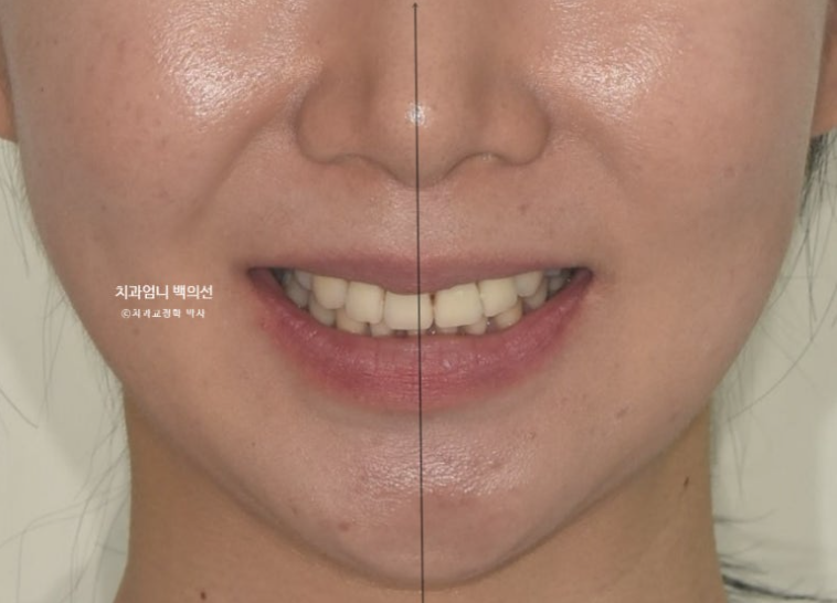 옥니 교정 역교정 재교정 무턱교정 치료기간 1년 10개월 관련 이미지 3