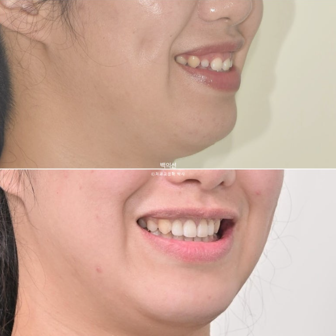 30대 치아교정 돌출입 교정 :: 잇몸미소 거미스마일 교정 입술부전증 결손치 무턱교정 관련 이미지 24