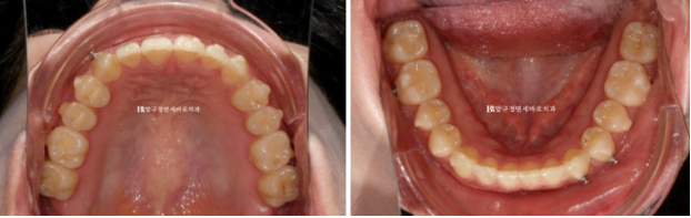 If Inward-Tilted Teeth Make Your Smile Look Constricted? Invisalign Before and After image 8