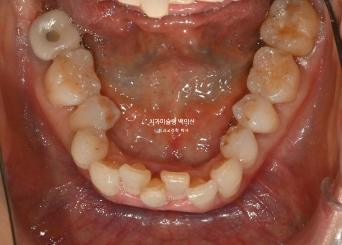 50대 치아교정 중년 발치교정 블랙트라이앵글 치료 후기 관련 이미지 6