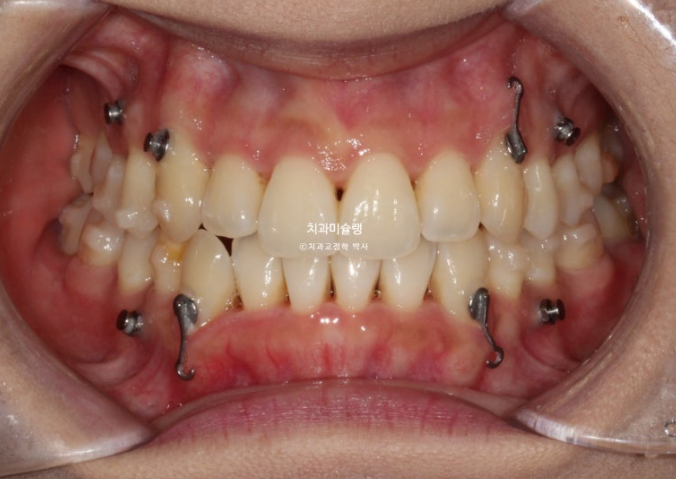 인비절라인 비발치 제2대구치 발치 사랑니 대체 교정 심한 덧니 교정 치료 관련 이미지 11