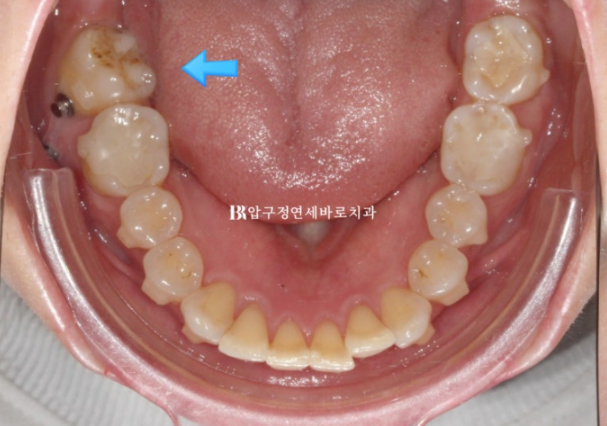 40대 인비절라인 라이트 가위교합? 관련 이미지 10