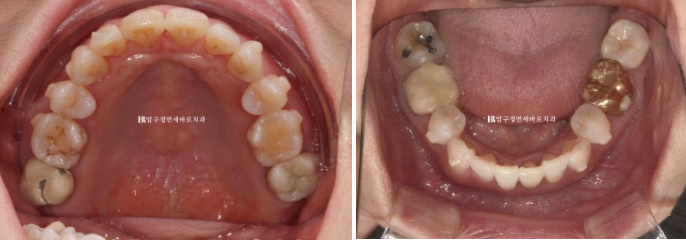 50대 치아교정 인비절라인 라이트 앞니교정 치료 후기 관련 이미지 8