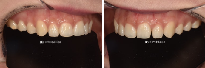 Before and After Non-Prep Veneers: Improving Gaps Between the Front Teeth and the Smile Line Together image 2