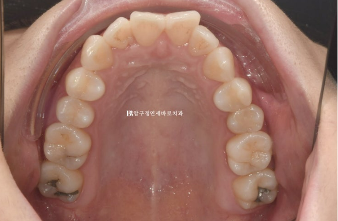 Can Rabbit Teeth Be Corrected? 5-Month Real Case of Butterfly Teeth Anterior Partial Orthodontic Treatment image 3