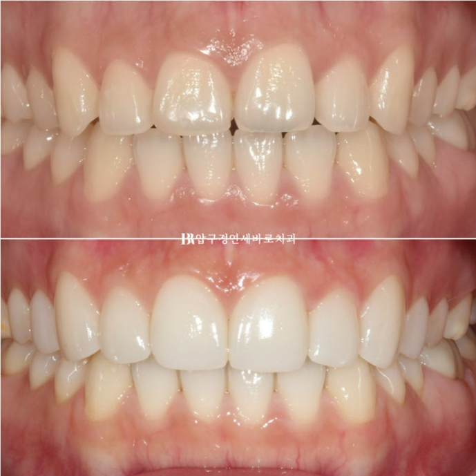 스마일라인 개선 무삭제 라미네이트 실제 두께 ? 관련 이미지 15