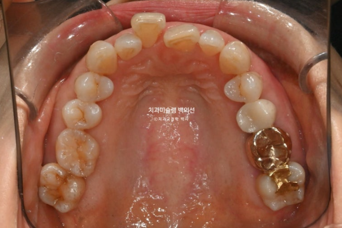 50대 치아교정 중년 발치교정 블랙트라이앵글 치료 후기 관련 이미지 5