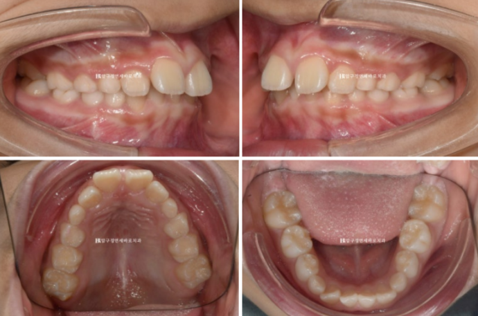 무턱교정 어린이 투명교정 인비절라인 퍼스트 교정 후기 관련 이미지 4