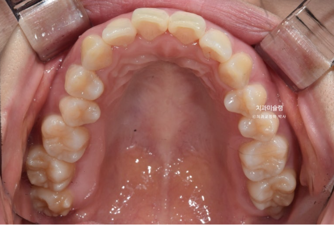 돌출입 덧니 발치 교정 인비절라인 교정 후기 관련 이미지 5