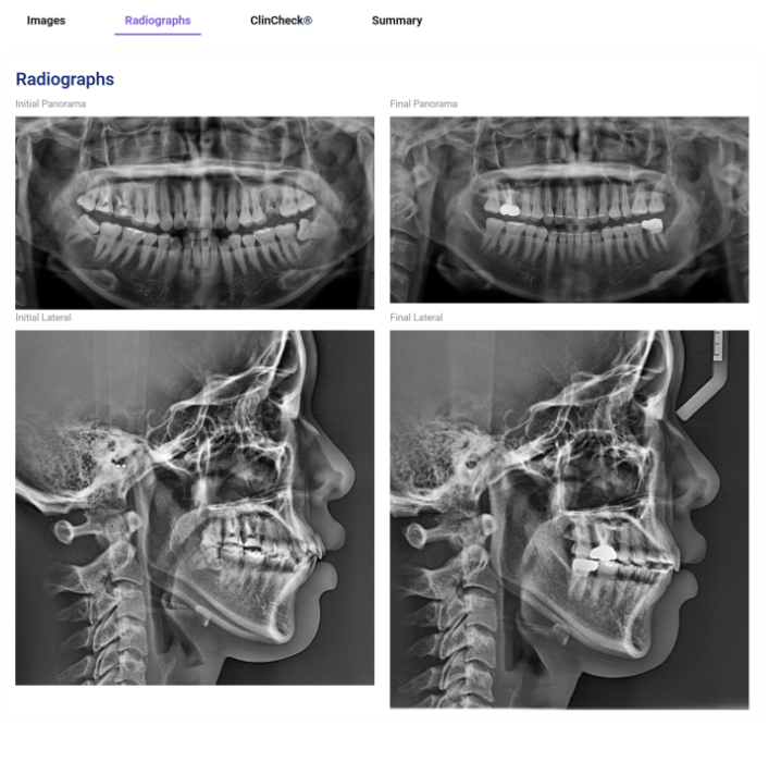 19번째 글로벌 갤러리 등재 소식 인비절라인 발치교정 부작용 ? 관련 이미지 3