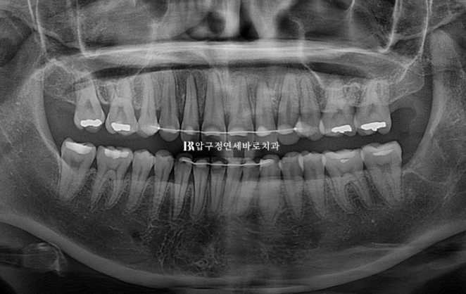 Does Invisalign Prevent Root Movement? Before-and-After Comparison of Extraction Treatment for Protruding Lips image 17