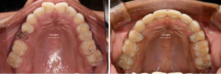 Extraction & re-orthodontics with Clippy-C, intrusion for dental implant. 관련 이미지 17
