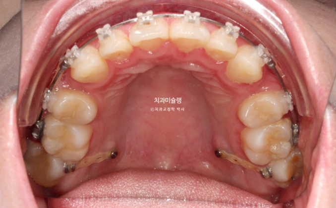심한 돌출입 입술부전증 호두주름 발치교정 치료 관련 이미지 9