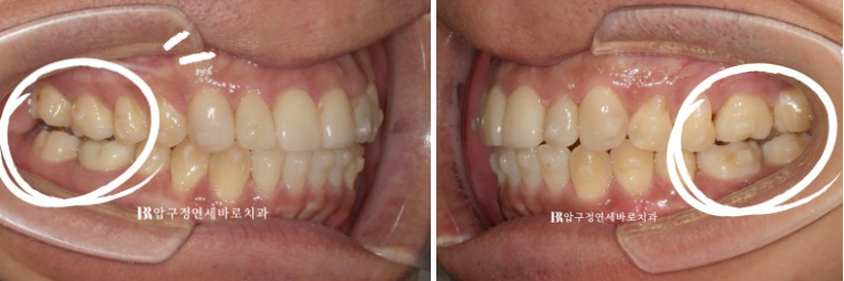 40대 치아교정 인비절라인 라이트 덧니 교정 어금니 교합 부작용 관련 이미지 9
